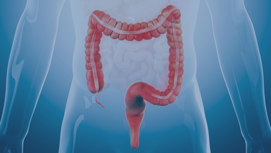 A graphic of a colon and rectum against an illustrated body reflect the concept of colorectal cancer.