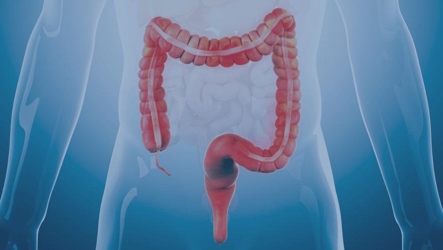 A graphic of a colon and rectum against an illustrated body reflect the concept of colorectal cancer.