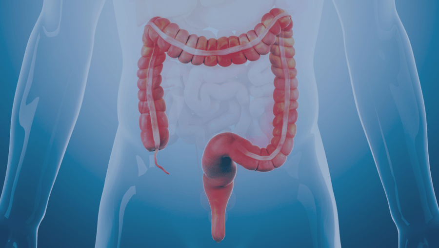 A graphic of a colon and rectum against an illustrated body reflect the concept of colorectal cancer.