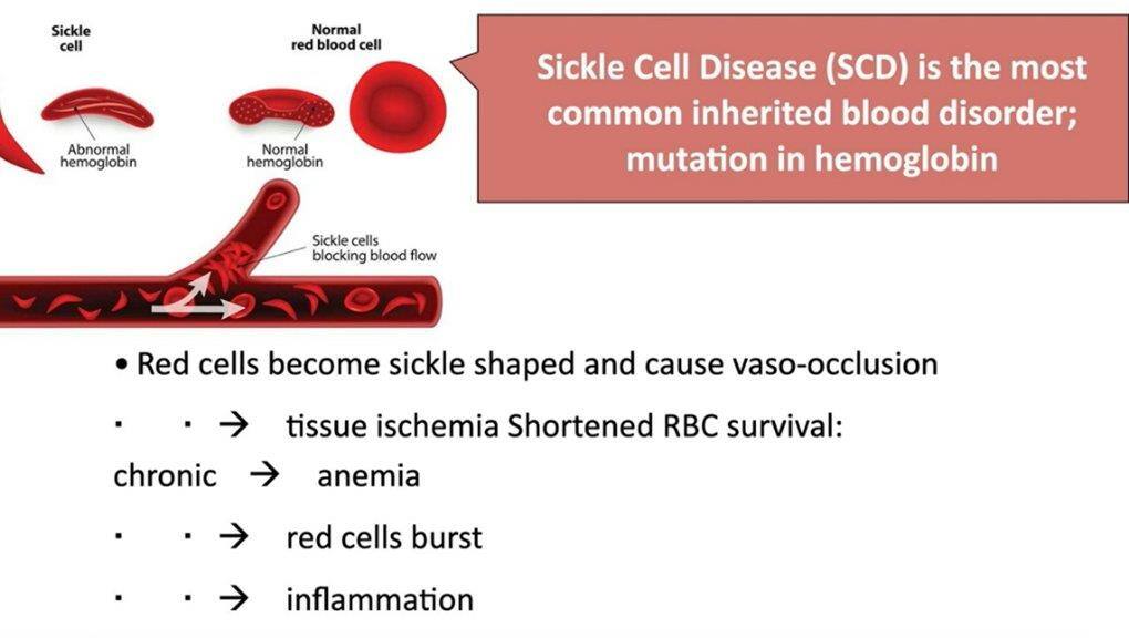 Understanding Sickle Cell Disease: Research, Pain Management, and ...