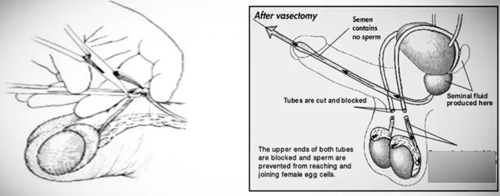 A diagram demonstrates how vasectomy surgery is performed, in this blog shared by the AHW Endowment